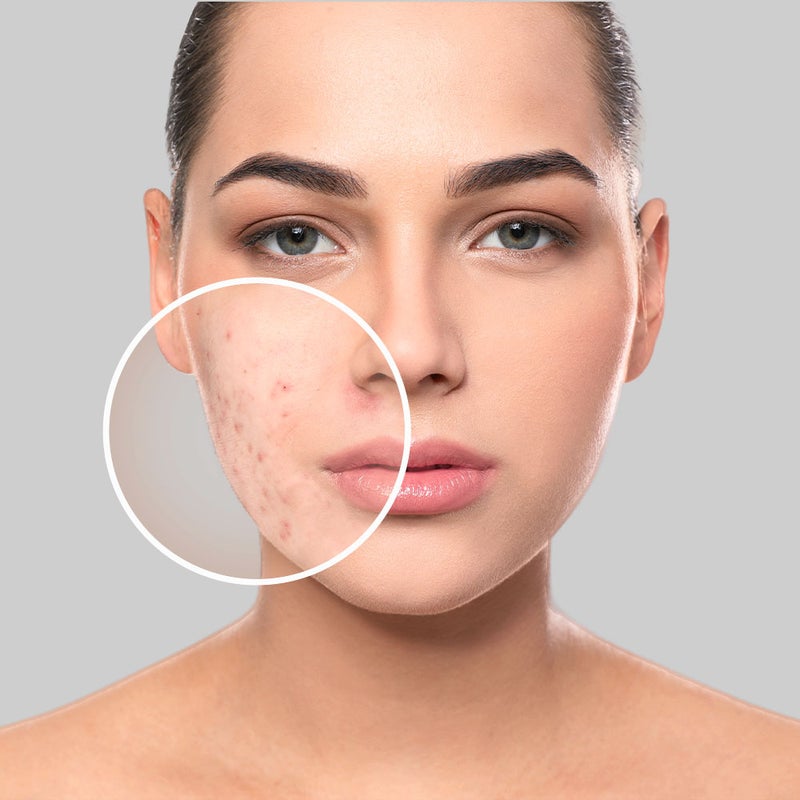 Acne Hormonal Test