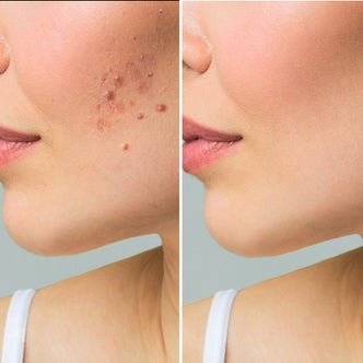 Scar Management/Carboxy